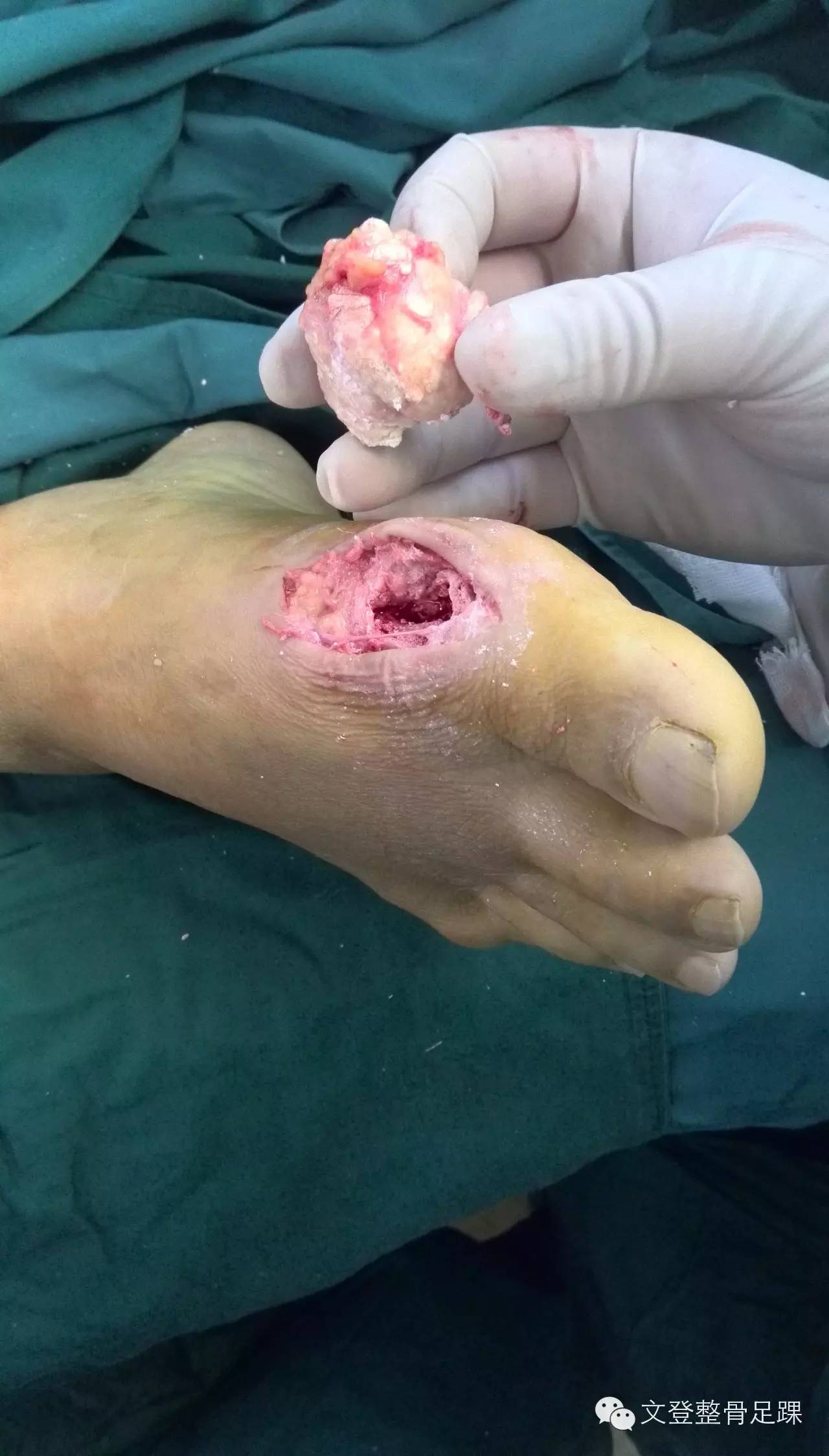 右足术 中外观痛风石原来是这外样子!