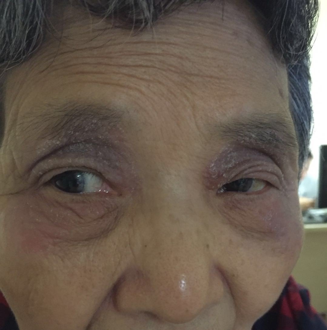 种眼药膏,叫妥布霉素地塞米松,效果有,但长期用下来两眼眼皮色素沉着