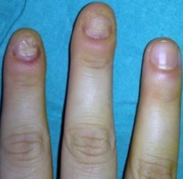 指甲咬变形怎么办?