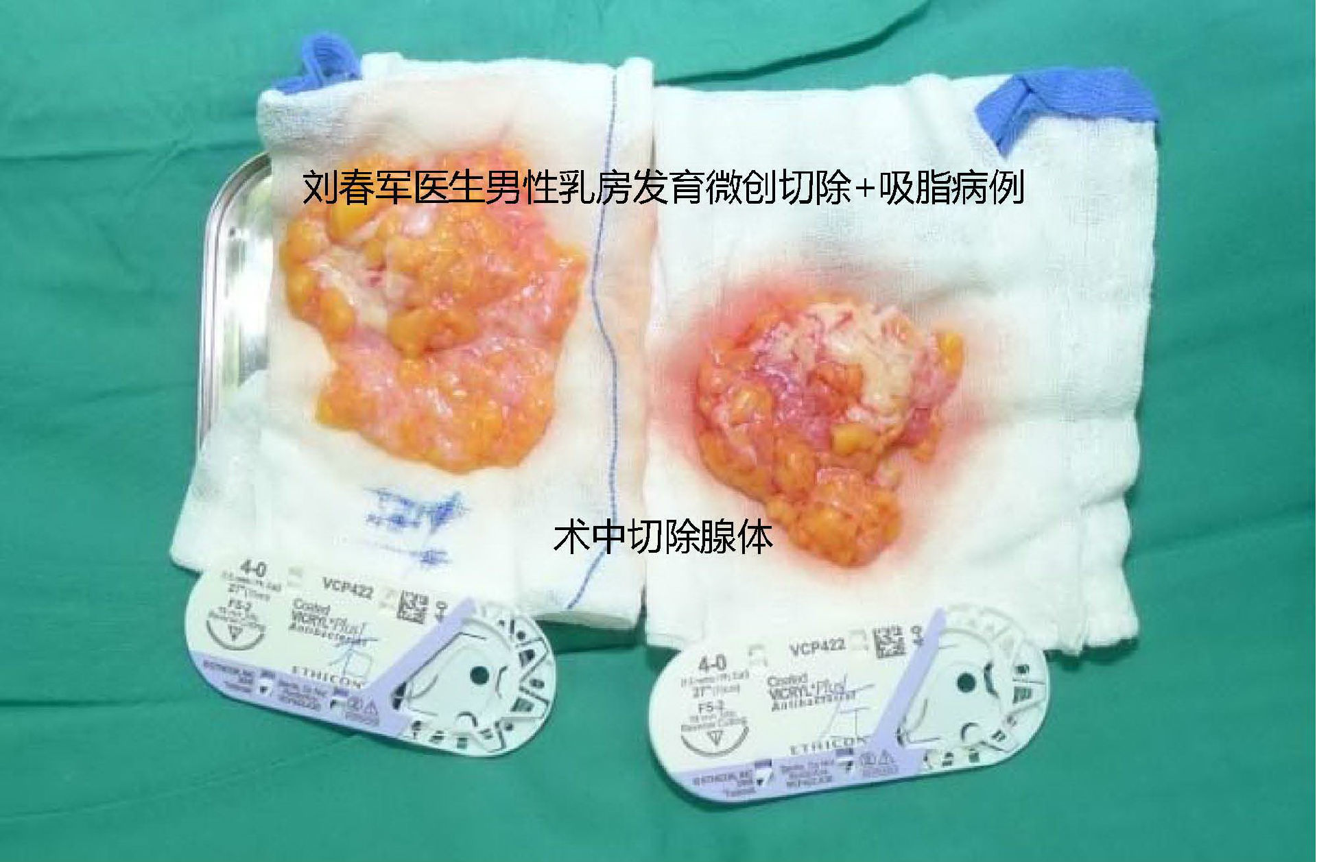原创男性乳房发育手术问答与护理附多组病例效果