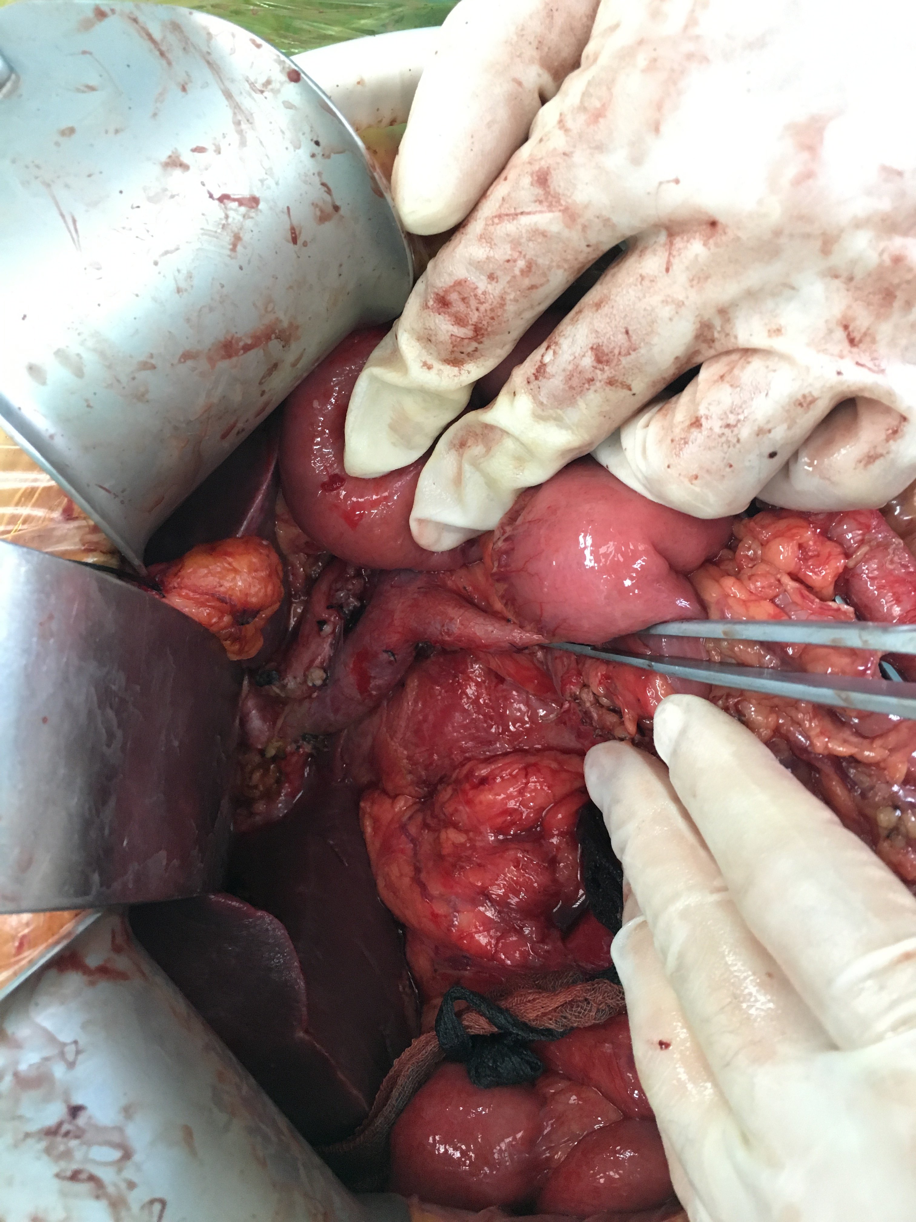 胰头钩突癌行胰十二指肠切除术