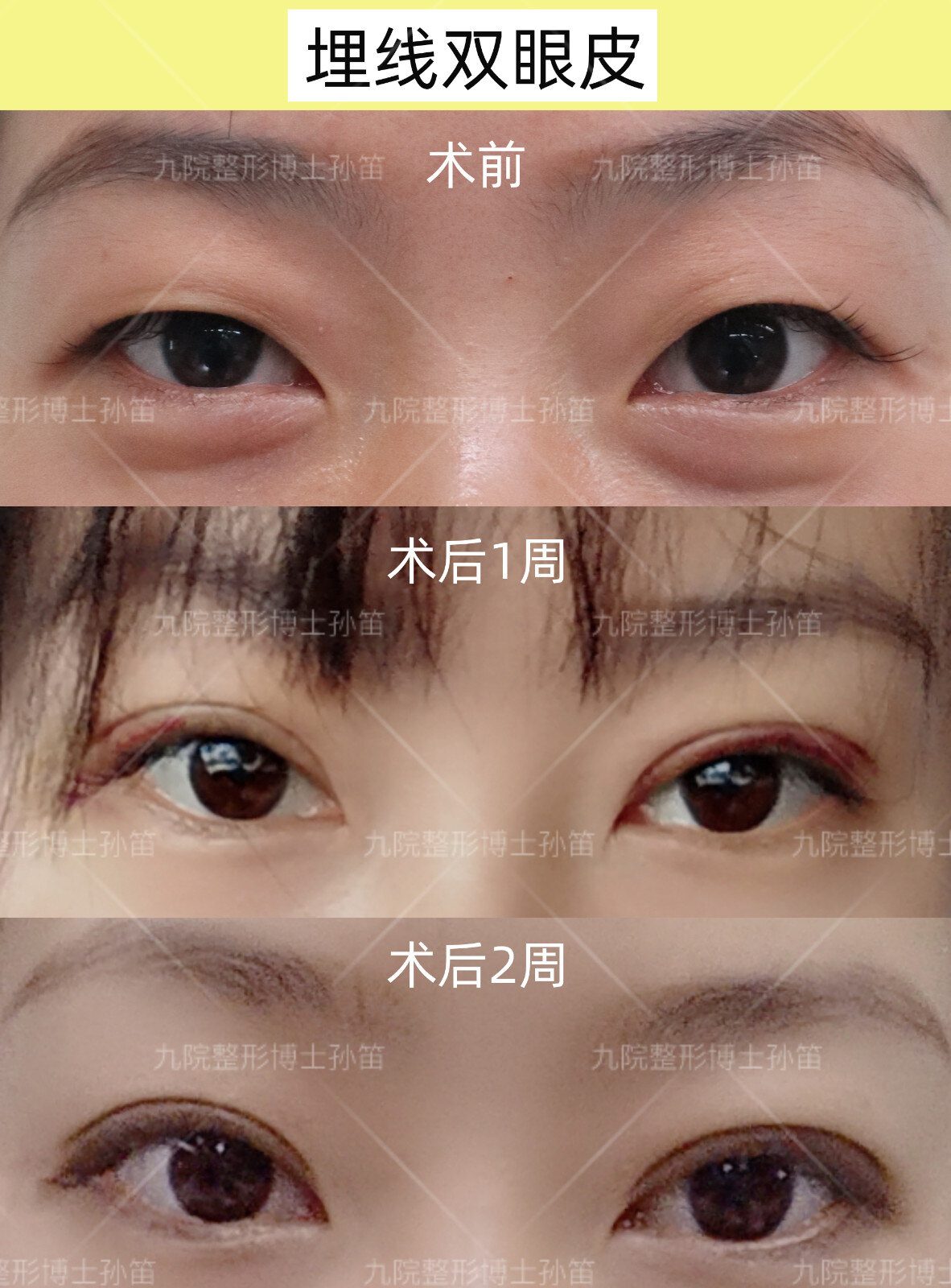 日本医美整容埋线双眼皮案例 - 知乎