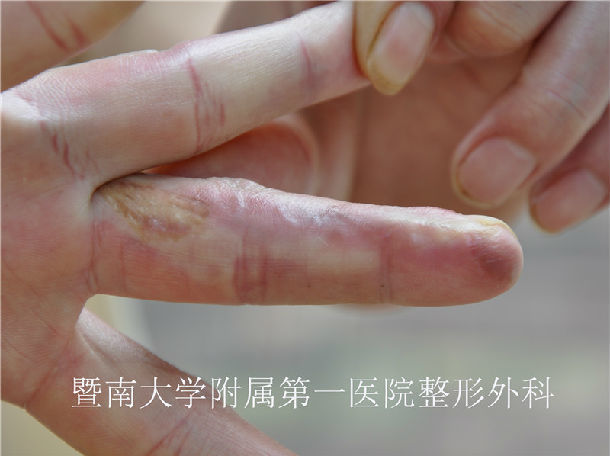 浑然天成指根部逆行岛状皮瓣修复指腹指端缺损效果观察