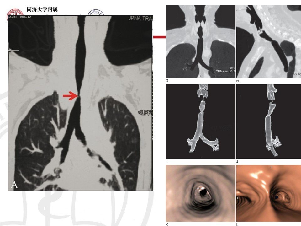 气管狭窄——气管插管/气管切开后狭窄是什么?如何治疗?