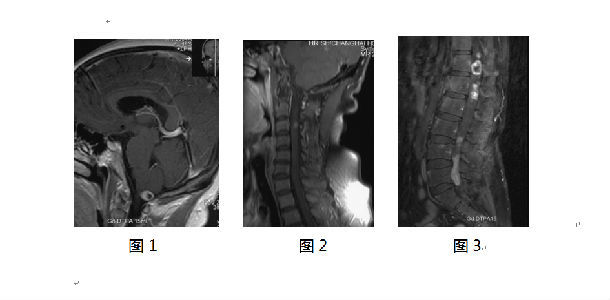 椎管内多发性神经鞘瘤一例报告及文献复习(以往发表论文)