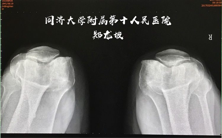 膝关节表面置换手术是根治膝关节骨关节炎的有效方法