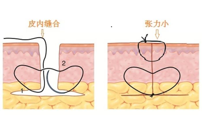图1无皮内缝合的普通外缝合,伤口张力较大.术后的疤痕可能会更明显.