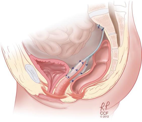子宫脱垂患者招募