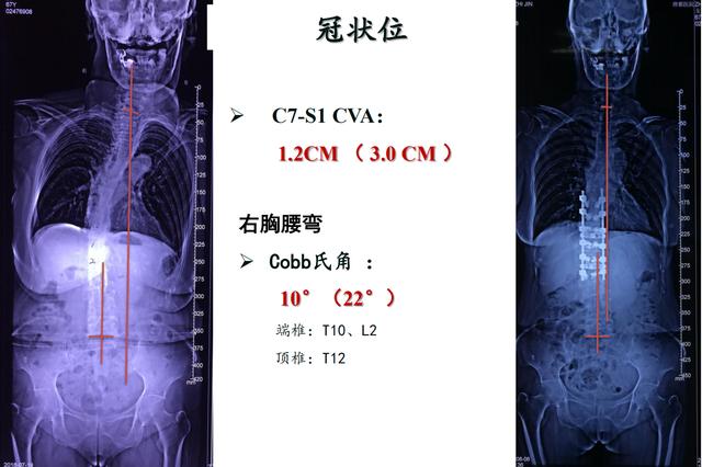 病例分享胸腰段脊柱后凸畸形