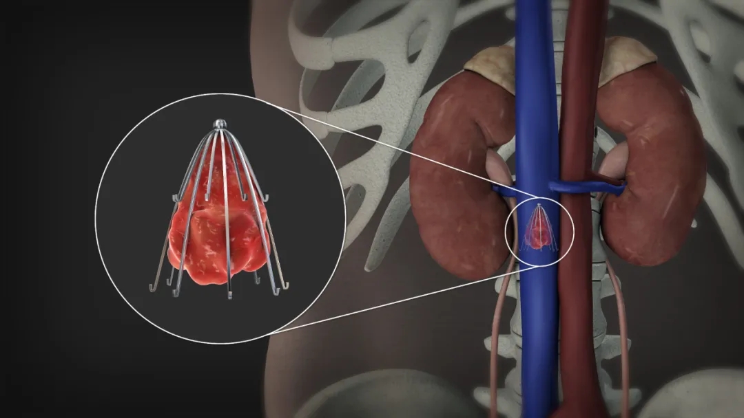 下腔静脉滤器类型图片