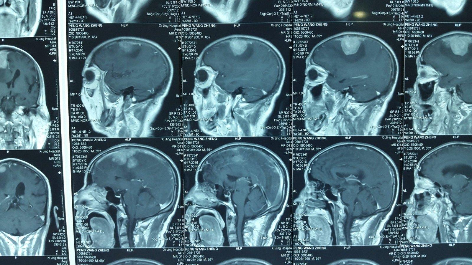 原发性中枢神经系统淋巴瘤非典型MRI影像学表现