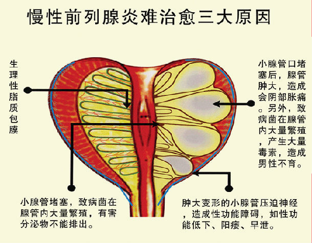 科学辨识前列腺炎:①排尿不适:常见尿频,尿急,排尿灼热刺痛感,疼痛可