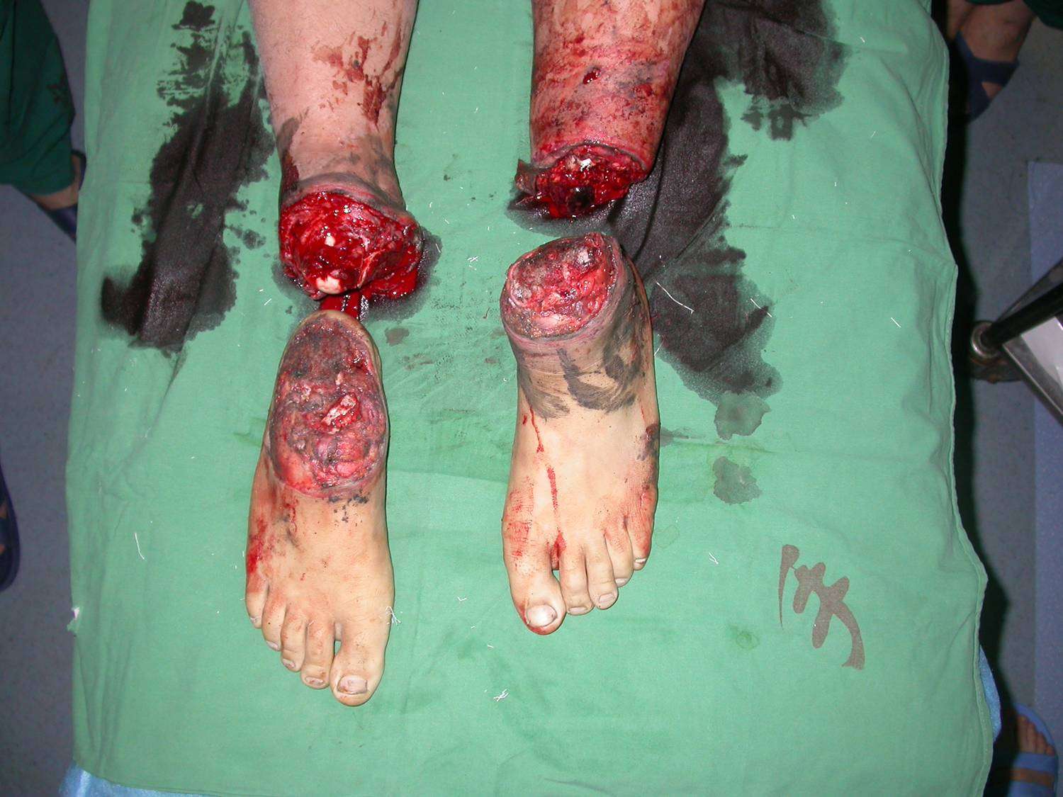 下肢严重外伤保还是截附保肢照片和刀锋战士照片