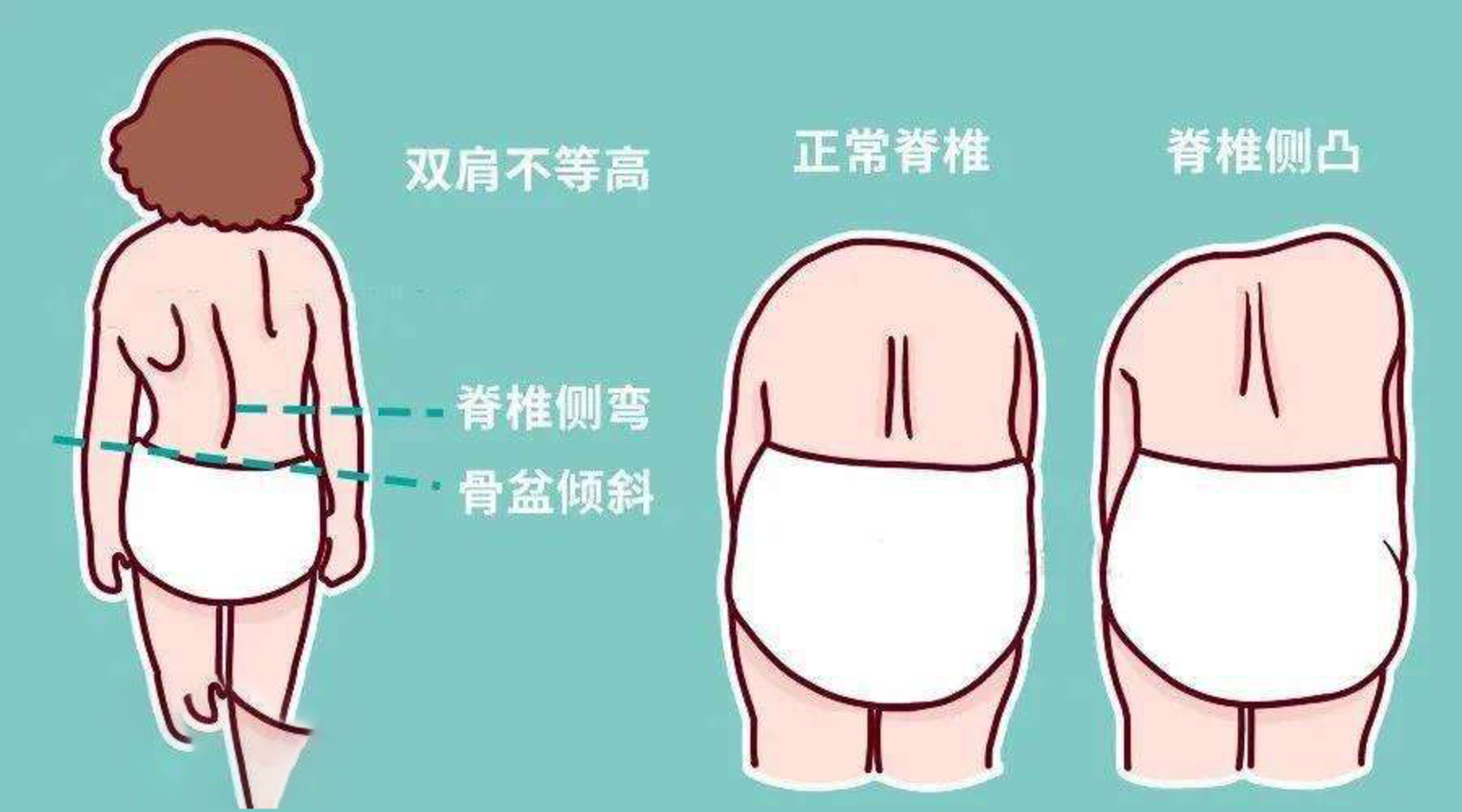 孩子左肩高右肩低怎么办