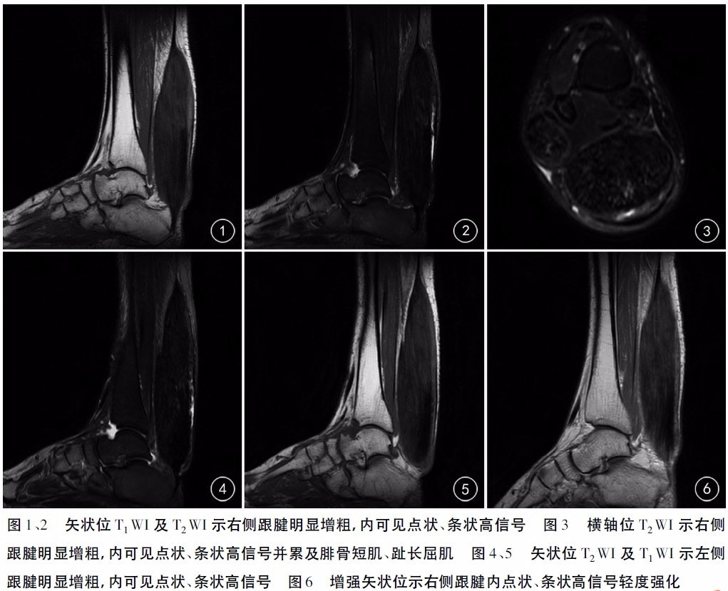 【肌腱炎/病】跟腱黄色瘤:高脂血症伴跟腱部肿块_沈炜亮医生文章_浙江