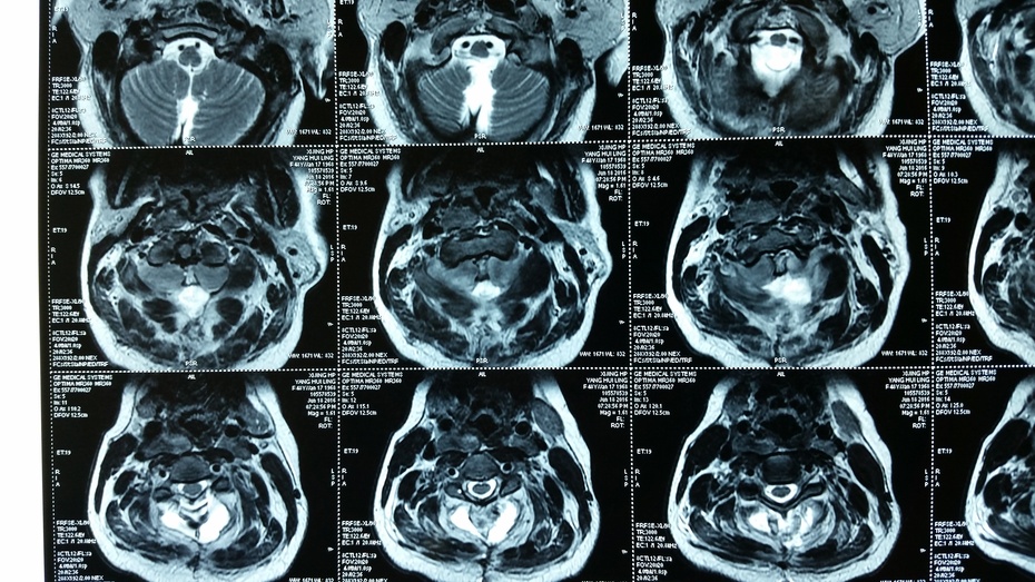 贺晓生教授枕颈交界区多发神经鞘瘤