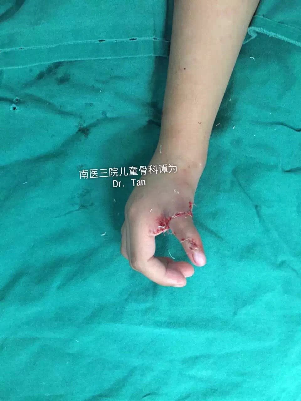 擅長：顏面骨外傷及面部輪廓整復、鼻唇畸形整復、手部燒創傷急救及先天后遺畸形治療與功能重...名醫掛號找黃牛，你掛不到的號我都可以的簡單介紹