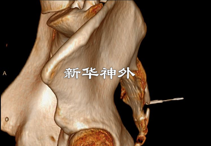 尾骨疼痛综合症治疗案例外伤