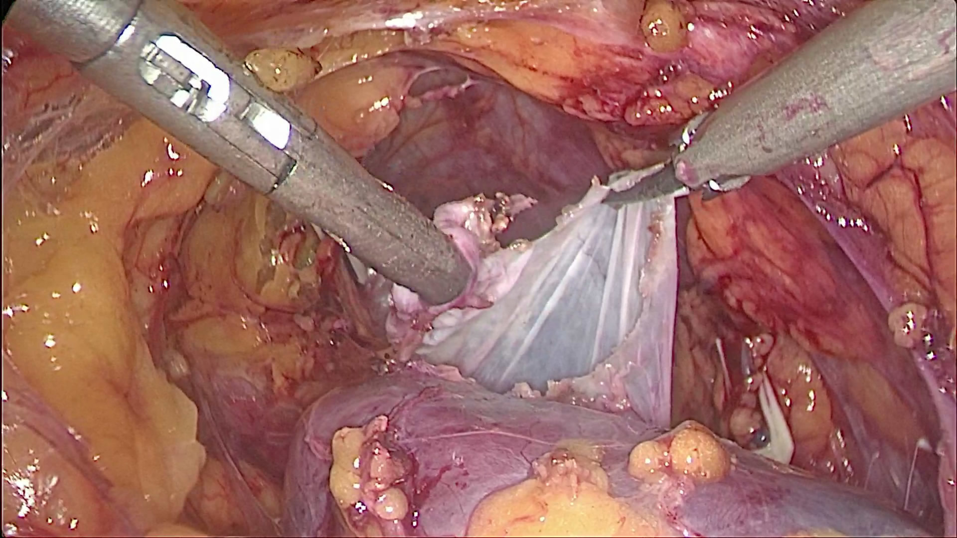 肾囊肿术后会复发和癌变吗