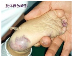 【科普知识】  儿童静脉畸形