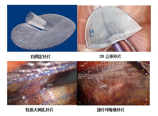 术后康复也要"量体裁衣"一些术后的患者,腹股沟处出现包块,误以为疝气