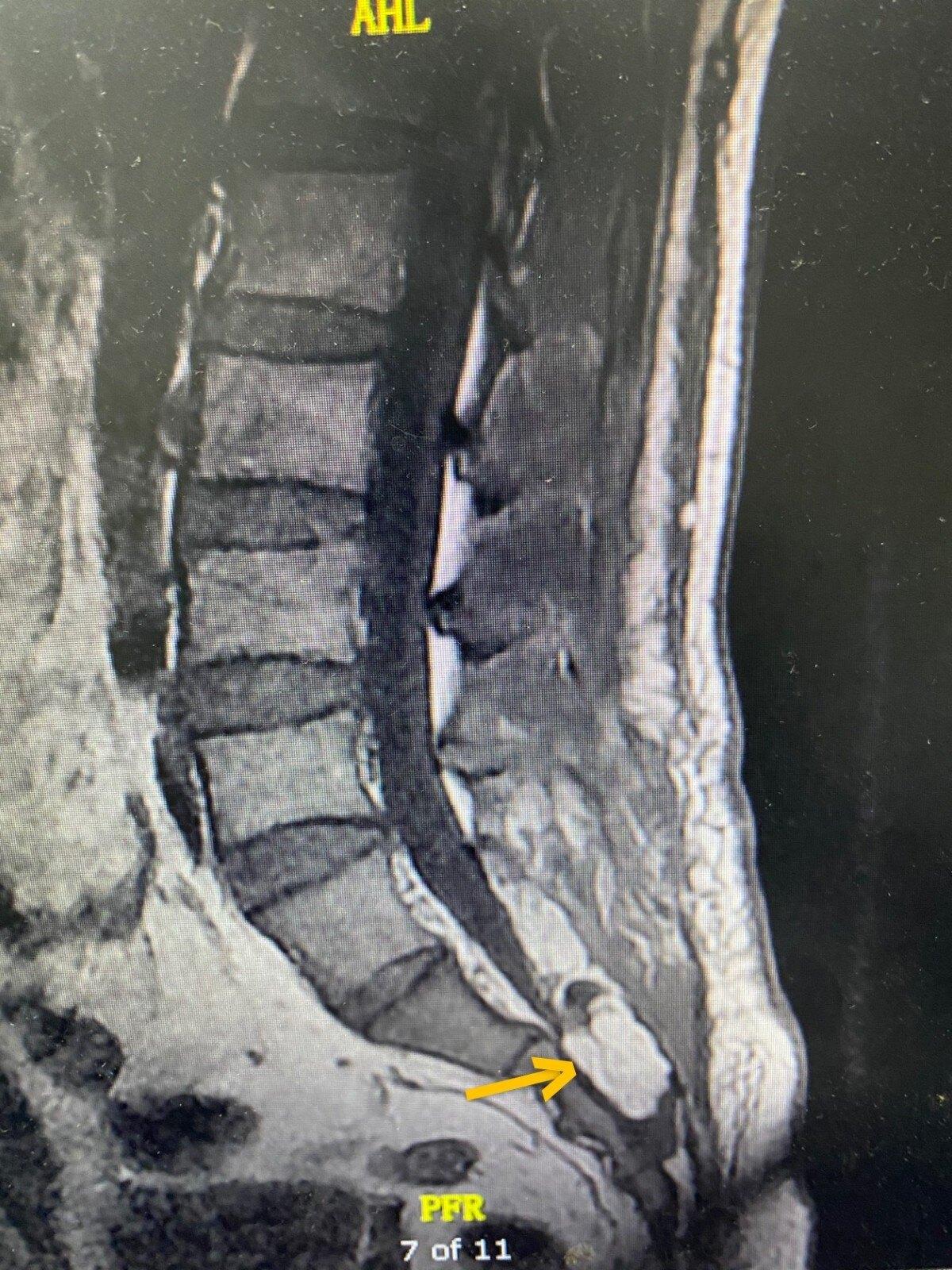 典型病例:骶管囊肿的微创内镜手术治疗,最关键技术决定良好手术效果