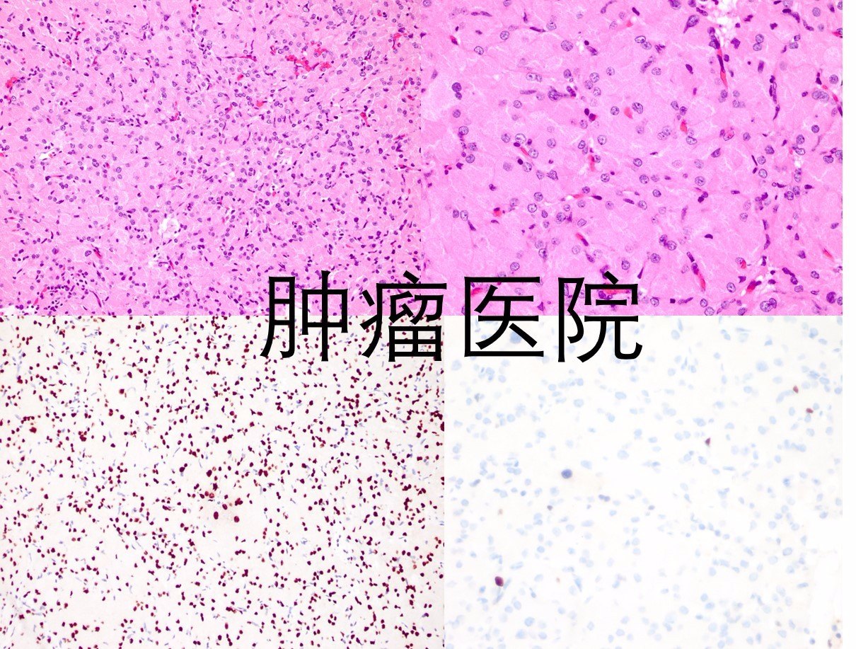 垂体颗粒细胞瘤图片