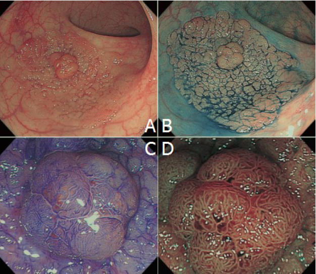 大肠侧向发育型肿瘤