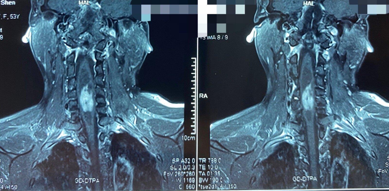 髓内室管膜瘤MRI影像表现