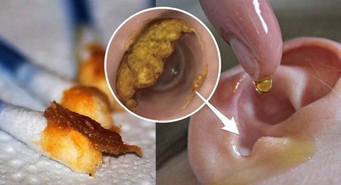 所以相对来说,干耳垢要比湿的好处理一些很多.