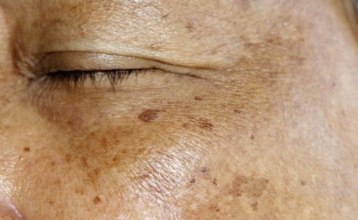 正常的人脸色红润,肝病患者则出现"肝病面容",表现为脸色暗沉,发黄