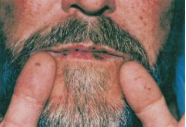 其他疾病:包括色素性扁平苔藓,carney综合征,豹斑综合征等.