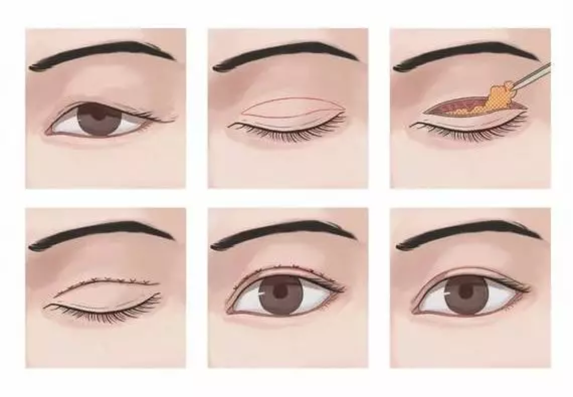 切开法重睑成形术重现永久性自然双眼皮