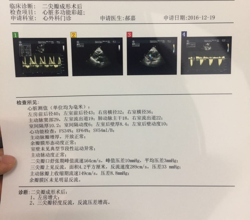 二尖瓣关闭不全是直接换瓣还是先考虑成形修复