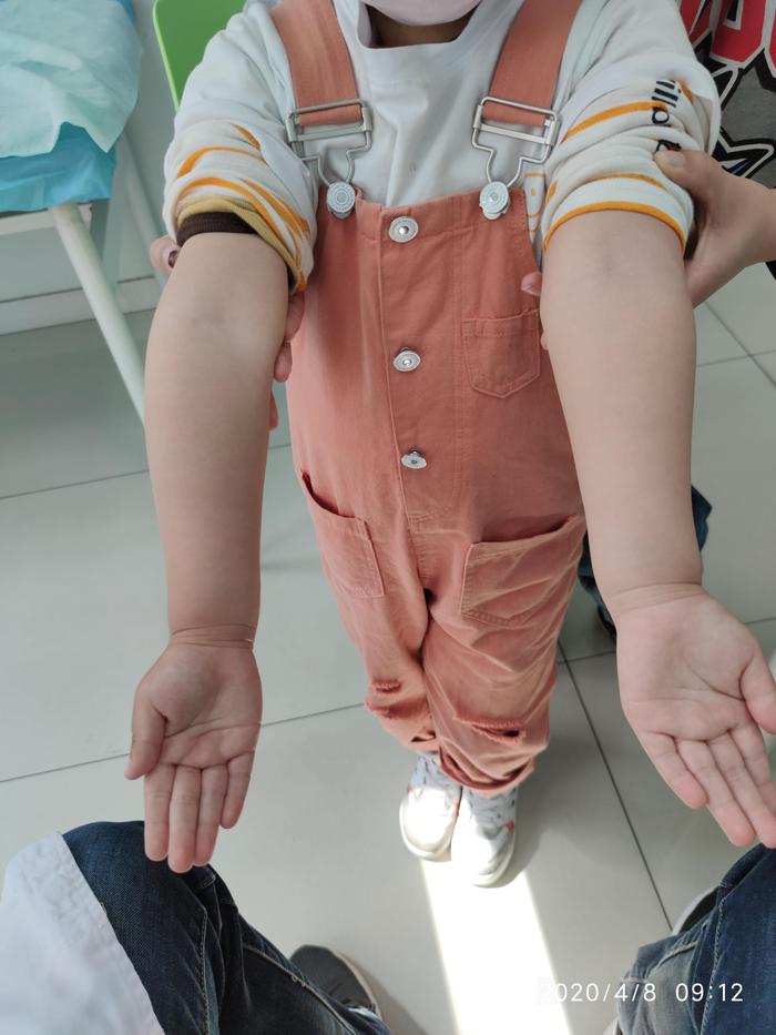 典型病例儿童肘内翻畸形的治疗