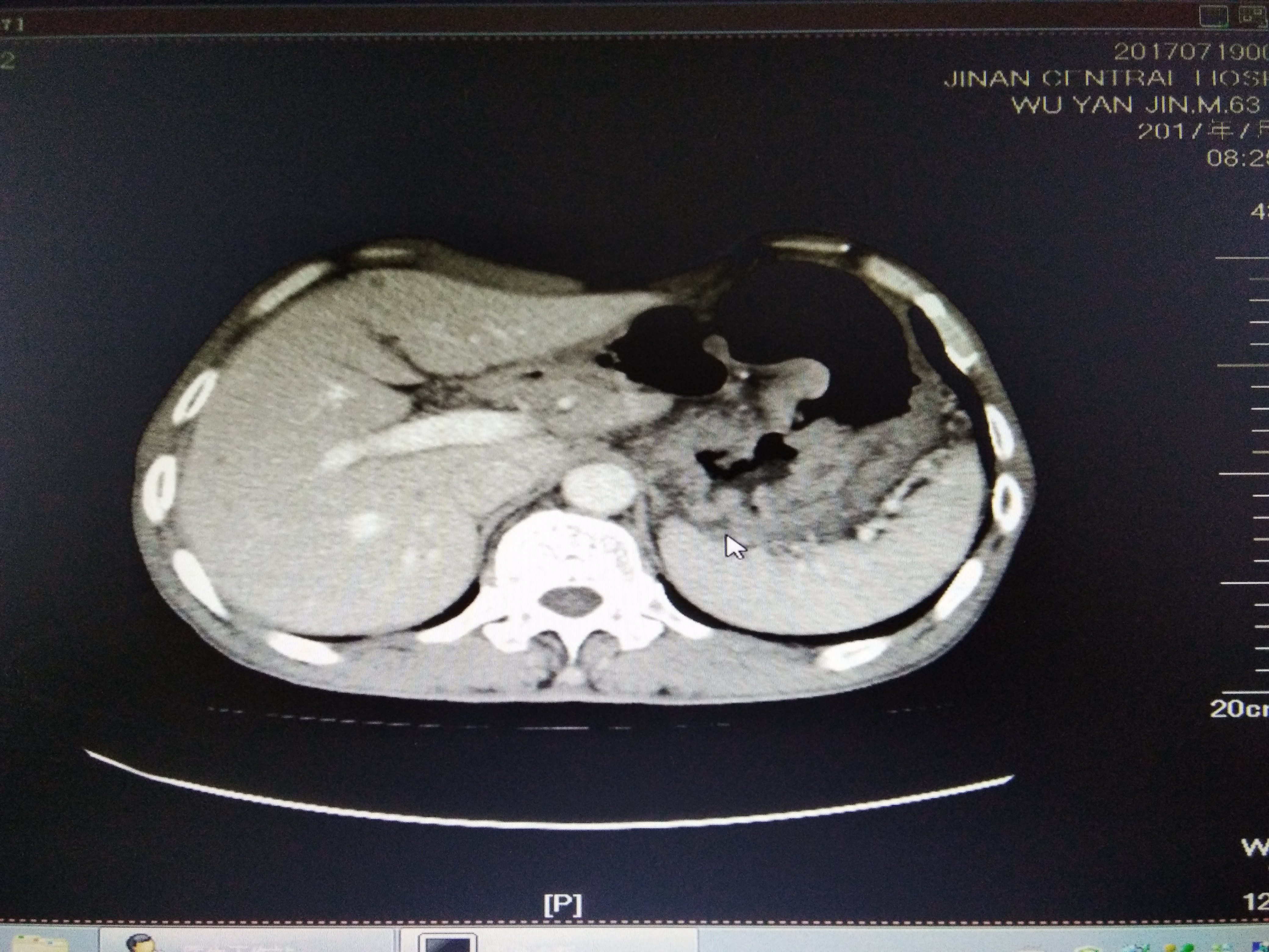 胃底贲门部腺癌更适合腹腔镜经腹及食管裂孔手术