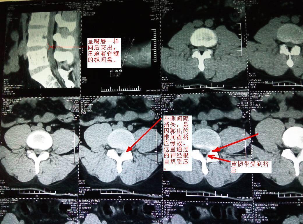 腰椎侧隐窝性疼痛解剖,病因与诊治