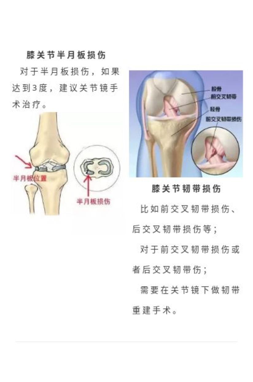 膝关节积液到底需不需要抽掉 健康号 微医