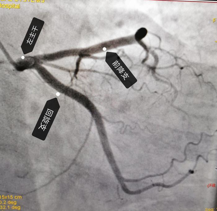 冠脉造影影像解读