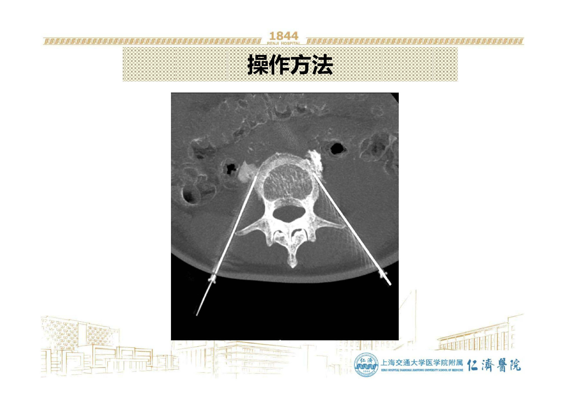 腰交感神经阻滞