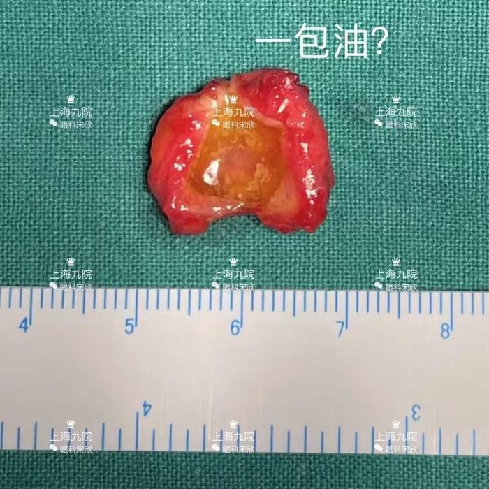 眼肿瘤系列科普眼眶囊肿