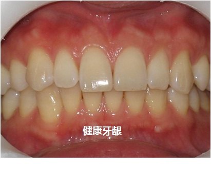 慢性牙周炎如何治疗