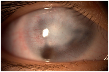 图1 先天性角膜白斑图2 正常眼睑及重度下垂眼睑图3 正常眼睛的透明