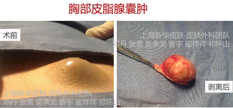 粉瘤是什么该怎么治总能挤出白色牙膏样东西