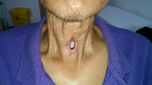 全喉切除病人的福音:发音钮重建患者发音功能! - 微医(挂号网)