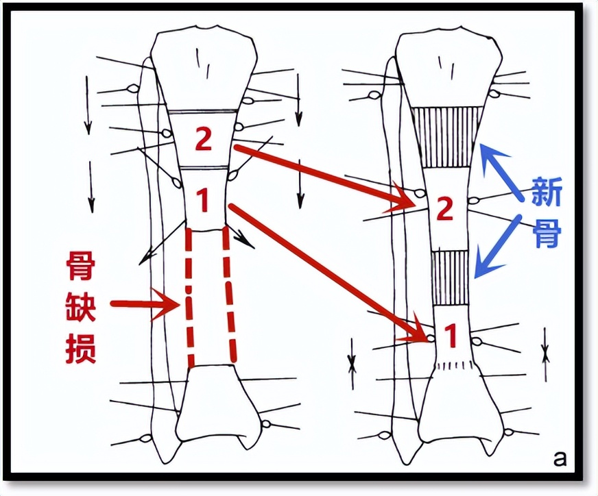 骨搬运技术是怎么让骨不连重新愈合的?
