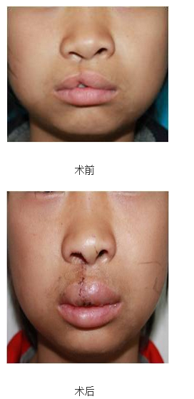 唇腭裂八大处序列治疗模式及术前术后注意事项