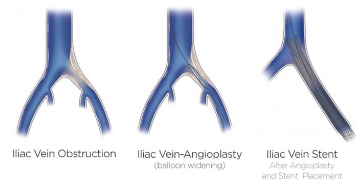 髂静脉支架置入术后简单一招可减少早期血栓形成