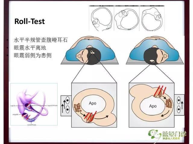 取平卧位,头位抬高30°,向一侧转头90°观察至眩晕或眼震消失后20s