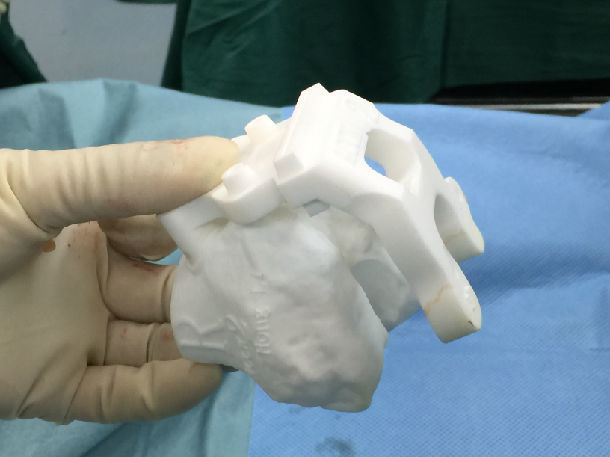 3d打印导板辅助膝关节置换